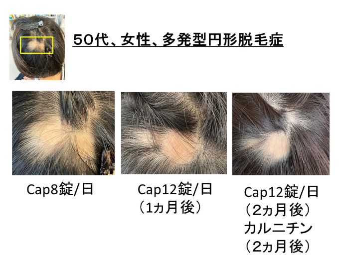 円形脱毛症　病院